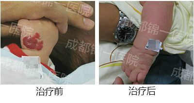 血管瘤较好的治疗方法