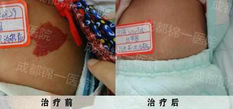 血管瘤较好的治疗方法