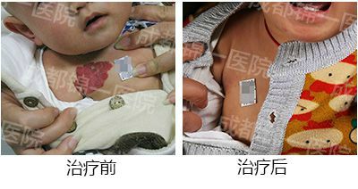血管瘤康复宝宝
