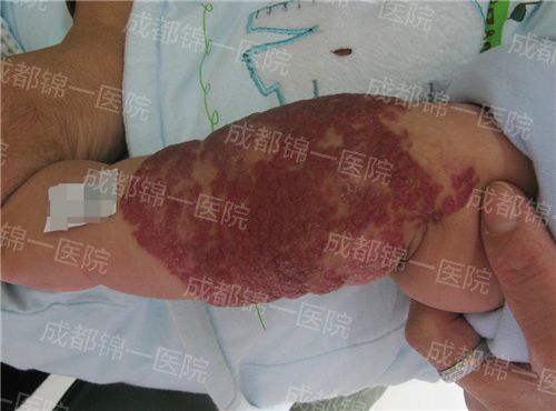 成都锦一医院血管瘤治疗