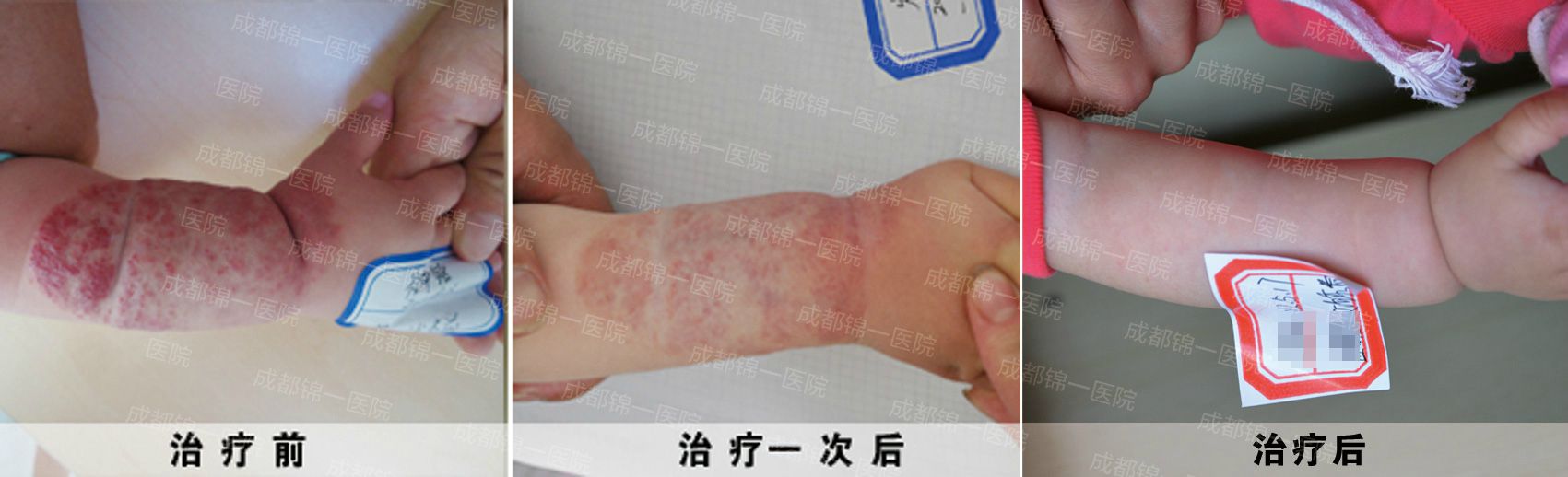 血管瘤宝宝治疗效果