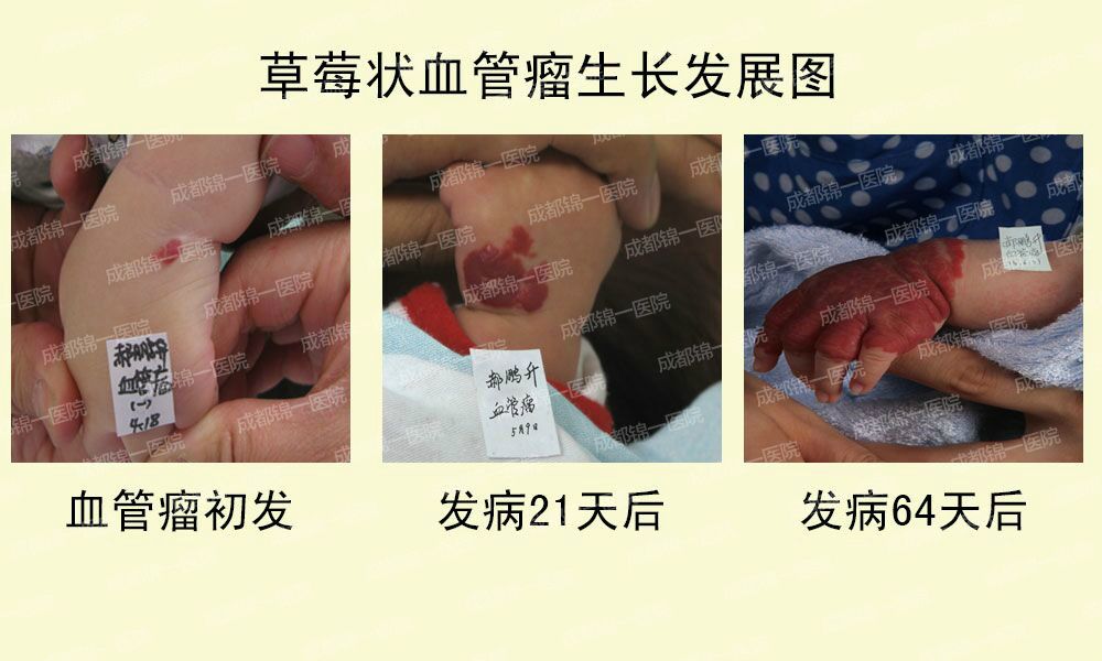 血管瘤自行消退吗?